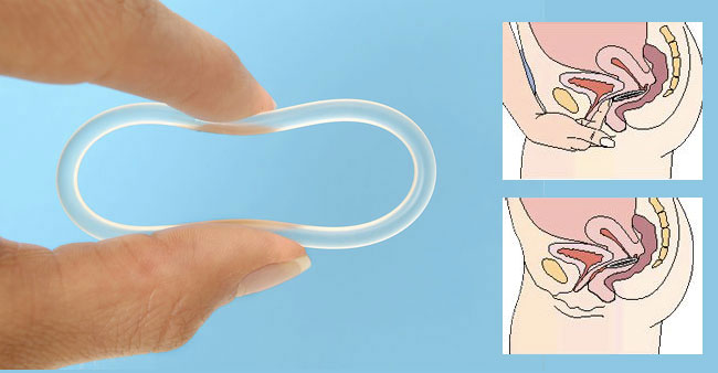 anneau contraceptif vaginal