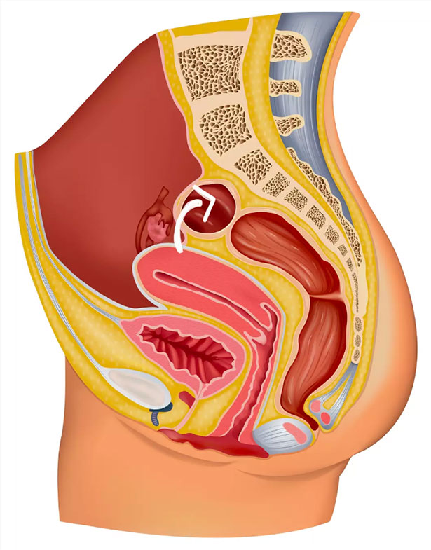 schéma d'un uterus rétroversé