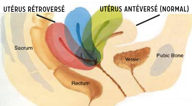 uterus rétroversé antéversé