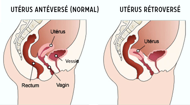 utérus rétroversé